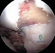 أدوات جراحة تنظير مفصل الورك الدقيقة