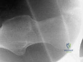 عملية نحت العظام وإزالة النتوءات بالمنظار