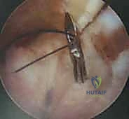 انحشار الكماشة وتأثيره على الحُق