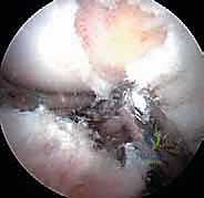 التطور التدريجي لتلف غضروف الورك