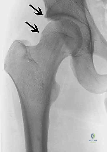 تمارين استعادة المدى الحركي للورك
