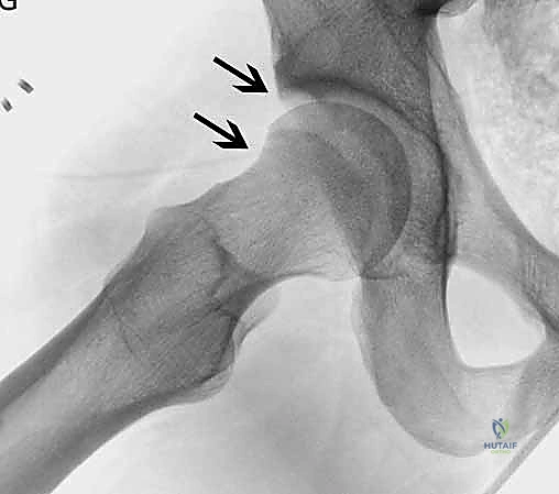 استخدام العكازات في المرحلة الأولى من التعافي