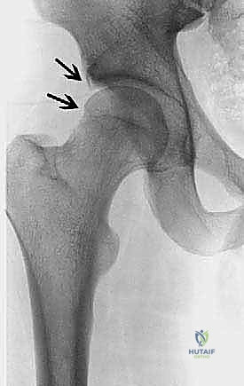 صورة توضيحية لـ انحشار الفخذ الحقي بالمنظار فهم شامل وعلاج متقدم للحفاظ على مفصل الورك مع الأستاذ الدكتور محمد هطيف