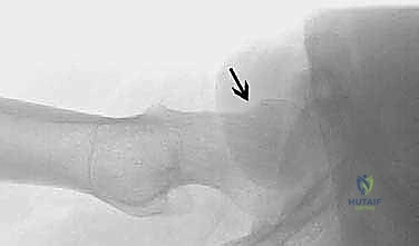 Illustration of femoral head neck - Dr. Mohammed Hutaif