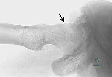 صورة توضيحية لـ انحشار الفخذ الحقي بالمنظار فهم شامل وعلاج متقدم للحفاظ على مفصل الورك مع الأستاذ الدكتور محمد هطيف