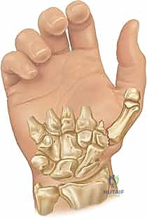 كسر رولاندو المفتت