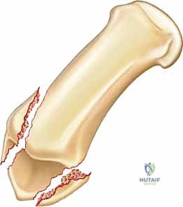 كسر بينيت في الإبهام