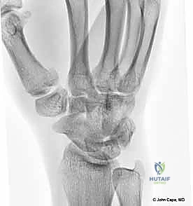 التصوير بالأشعة السينية لكسور الإبهام