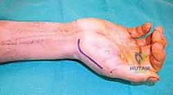 صورة توضيحية لـ دليلك الشامل لكسور مفصل إبهام اليد الرسغي السنعي: التشخيص والعلاج مع الأستاذ الدكتور محمد هطيف