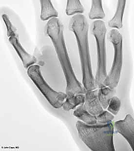 التثبيت الداخلي بالشرائح والمسامير