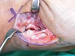 صورة توضيحية لـ دليلك الشامل لكسور مفصل إبهام اليد الرسغي السنعي: التشخيص والعلاج مع الأستاذ الدكتور محمد هطيف