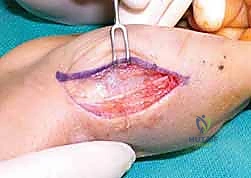 صورة توضيحية لـ دليلك الشامل لكسور مفصل إبهام اليد الرسغي السنعي: التشخيص والعلاج مع الأستاذ الدكتور محمد هطيف