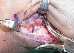 صورة طبية: دليلك الشامل لكسور مفصل إبهام اليد الرسغي السنعي: التشخيص والعلاج مع الأستاذ الدكتور محمد هطيف