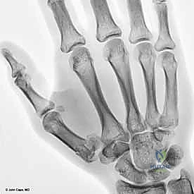 صورة طبية: دليلك الشامل لكسور مفصل إبهام اليد الرسغي السنعي: التشخيص والعلاج مع الأستاذ الدكتور محمد هطيف