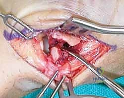 صورة توضيحية لـ دليلك الشامل لكسور مفصل إبهام اليد الرسغي السنعي: التشخيص والعلاج مع الأستاذ الدكتور محمد هطيف