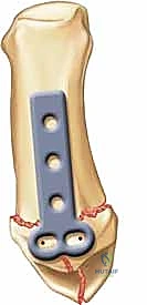 التثبيت المغلق بالإبر المعدنية