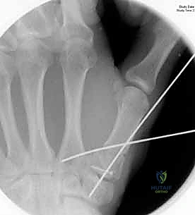 صورة طبية: دليلك الشامل لكسور مفصل إبهام اليد الرسغي السنعي: التشخيص والعلاج مع الأستاذ الدكتور محمد هطيف