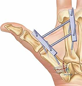 صورة طبية: دليلك الشامل لكسور مفصل إبهام اليد الرسغي السنعي: التشخيص والعلاج مع الأستاذ الدكتور محمد هطيف