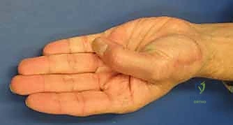 صورة طبية: دليلك الشامل لكسور مفصل إبهام اليد الرسغي السنعي: التشخيص والعلاج مع الأستاذ الدكتور محمد هطيف