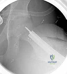 الأستاذ الدكتور محمد هطيف أثناء إجراء جراحة دقيقة