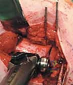 قطع عظم الفخذ الدوراني القريب لتصحيح الانحراف الأمامي: خبرة الأستاذ الدكتور محمد هطيف