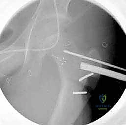 التصوير المقطعي لقياس انحراف عظم الفخذ