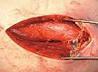 صورة توضيحية لـ قطع عظم الفخذ الدوراني القريب لتصحيح الانحراف الأمامي: خبرة الأستاذ الدكتور محمد هطيف