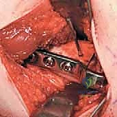 صورة توضيحية لـ قطع عظم الفخذ الدوراني القريب لتصحيح الانحراف الأمامي: خبرة الأستاذ الدكتور محمد هطيف