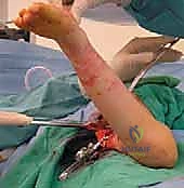 Proximal Femoral Derotational Osteotomy: An Operative Masterclass with 90-Degree AO Blade Plate