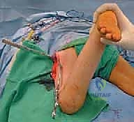 ميكانيكا مفصل الورك وتأثير الدوران