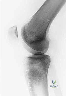 استئصال الجزء القريب من عظم الساق (الظنبوب) وإعادة البناء بالطرف الصناعي: دليل شامل للمرضى