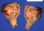 تغطية الأنسجة الرخوة