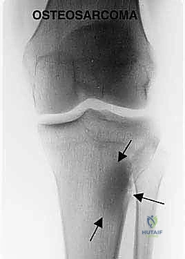 صورة توضيحية لـ استئصال الجزء القريب من عظم الساق