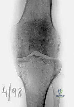 إعادة بناء آلية الباسطة
