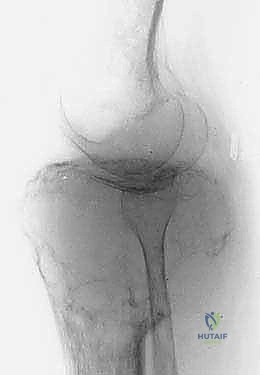 مرحلة من مراحل الجراحة