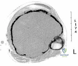 خطوات استئصال الظنبوب
