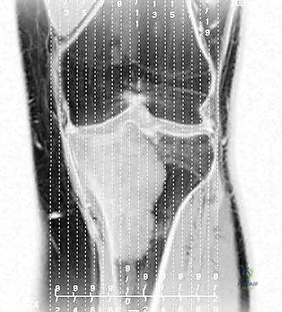 تلف شديد في العظم