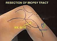 صورة توضيحية لـ استئصال الجزء القريب من عظم الساق (الظنبوب) وإعادة البناء بالطرف الصناعي: دليل شامل للمرضى
