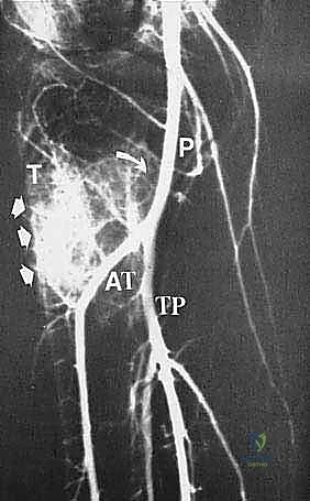 صورة توضيحية لـ استئصال الجزء القريب من عظم الساق (الظنبوب) وإعادة البناء بالطرف الصناعي: دليل شامل للمرضى