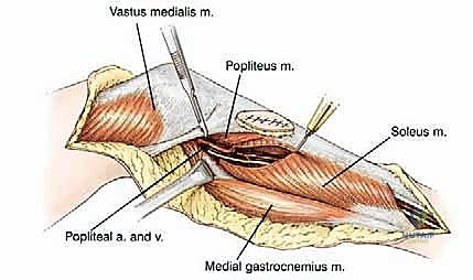 صورة طبية: استئصال الجزء القريب من عظم الساق (الظنبوب) وإعادة البناء بالطرف الصناعي: دليل شامل للمرضى