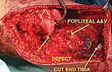 صورة طبية: استئصال الجزء القريب من عظم الساق (الظنبوب) وإعادة البناء بالطرف الصناعي: دليل شامل للمرضى