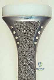 صورة طبية: استئصال الجزء القريب من عظم الساق (الظنبوب) وإعادة البناء بالطرف الصناعي: دليل شامل للمرضى