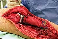صورة طبية: استئصال الجزء القريب من عظم الساق (الظنبوب) وإعادة البناء بالطرف الصناعي: دليل شامل للمرضى