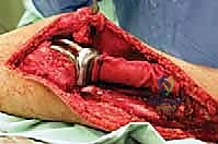 صورة طبية: استئصال الجزء القريب من عظم الساق (الظنبوب) وإعادة البناء بالطرف الصناعي: دليل شامل للمرضى