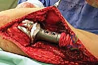 صورة طبية: استئصال الجزء القريب من عظم الساق (الظنبوب) وإعادة البناء بالطرف الصناعي: دليل شامل للمرضى