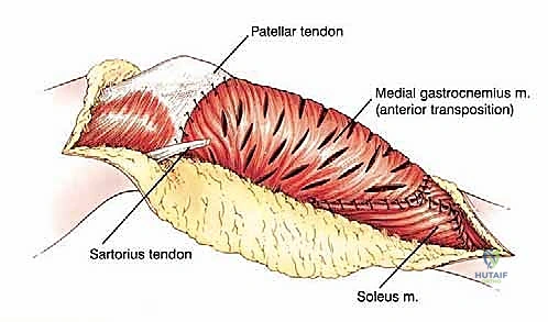 صورة طبية: استئصال الجزء القريب من عظم الساق (الظنبوب) وإعادة البناء بالطرف الصناعي: دليل شامل للمرضى