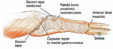 صورة طبية: استئصال الجزء القريب من عظم الساق (الظنبوب) وإعادة البناء بالطرف الصناعي: دليل شامل للمرضى