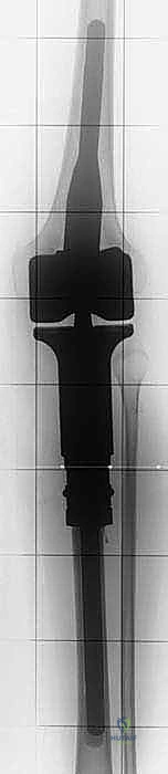 صورة طبية: استئصال الجزء القريب من عظم الساق (الظنبوب) وإعادة البناء بالطرف الصناعي: دليل شامل للمرضى