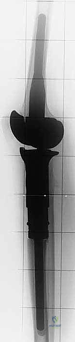 صورة طبية: استئصال الجزء القريب من عظم الساق (الظنبوب) وإعادة البناء بالطرف الصناعي: دليل شامل للمرضى