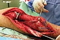 صورة طبية: استئصال الجزء القريب من عظم الساق (الظنبوب) وإعادة البناء بالطرف الصناعي: دليل شامل للمرضى